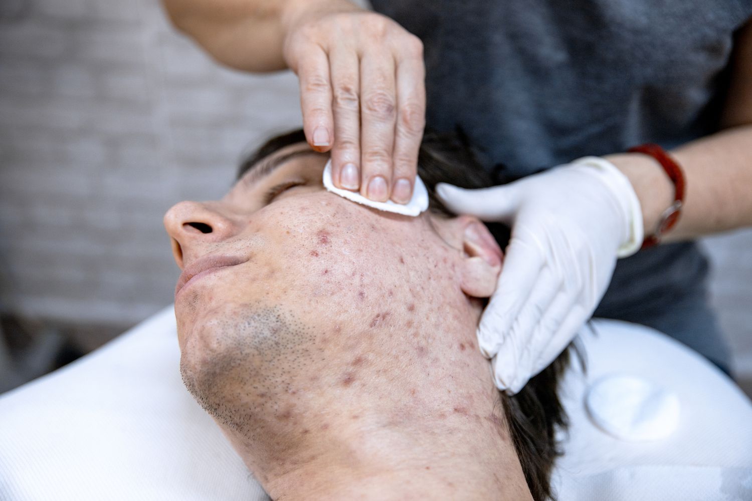 Acne Treatment - Discovering The Best Acne Treatment Options