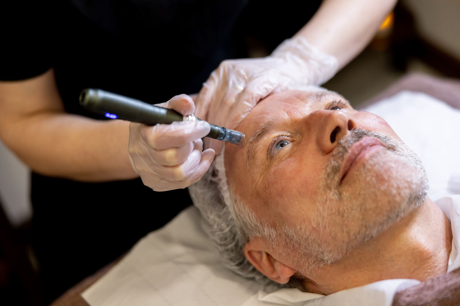 Microneedling For Hair Loss - Reviving Your Roots